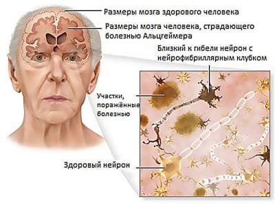 Перевозка больного с болезнью Альцгеймера